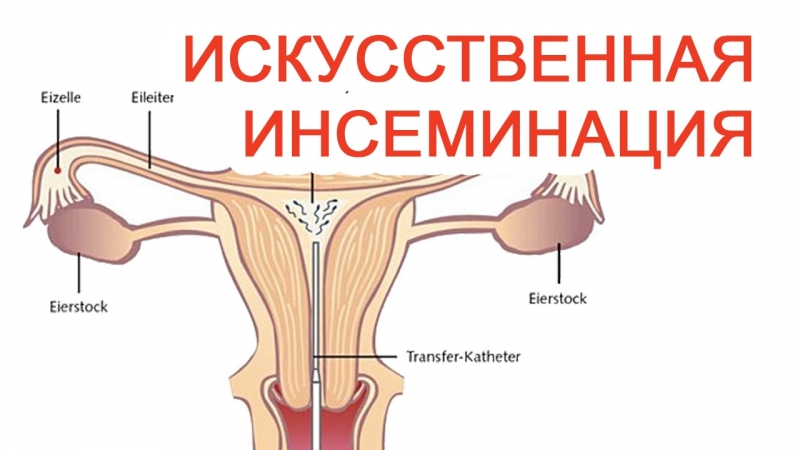 Искусственная инсеминация