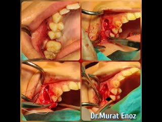 Oroantral fistula closure with buccal fat pad flap