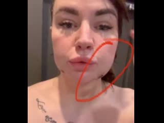 Саша черно рыдает после пластической операции нос в одну сторону, а губы в другую