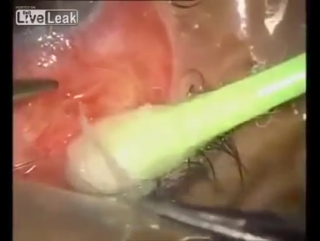 Удаление червя из глаза2