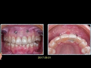 Screw invisalign part 2 ортодонтия