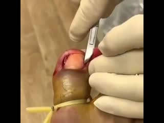 Резекция вросшего ногтя