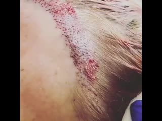 Пересадка волос