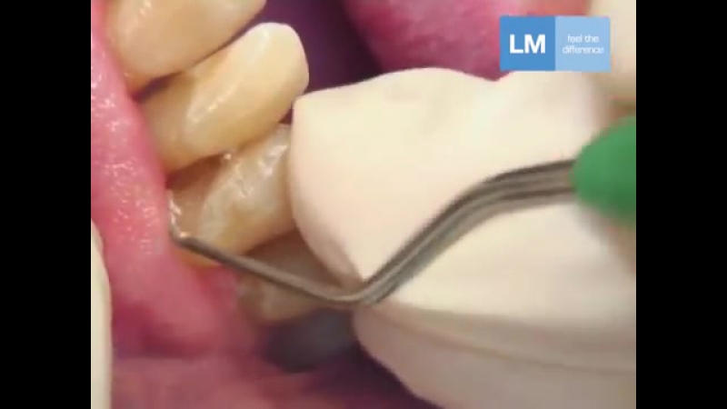 Clinical use of gracey 7 8 пародонтология