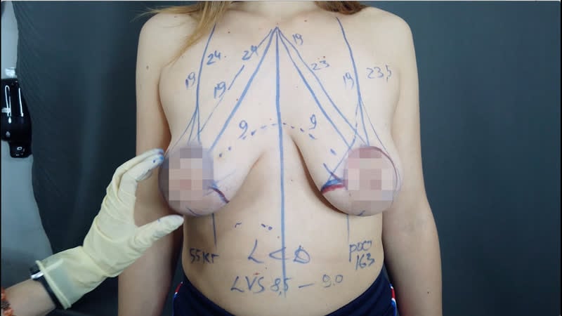 "я всегда стеснялась своей груди" подтяжка груди без имплантов