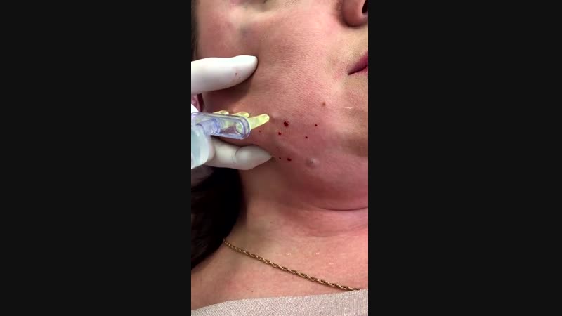 Ферментный липолиз нижней трети лица и подбородка