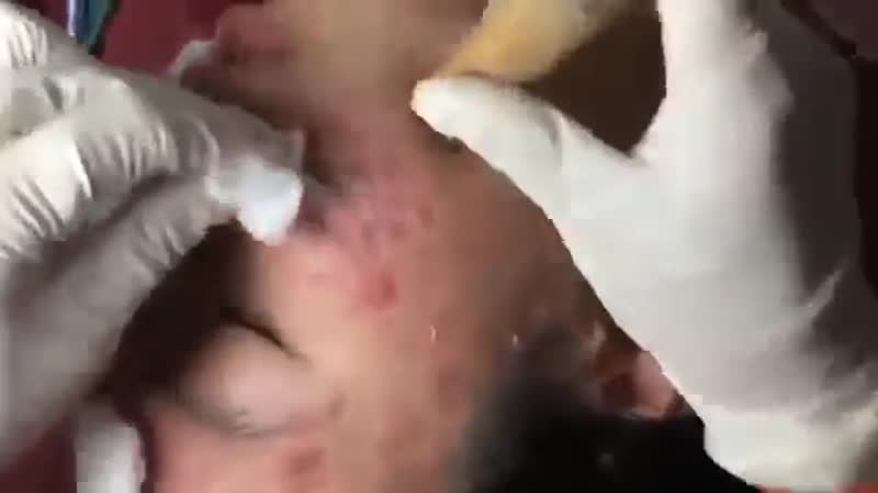 Угри porn video – Угри, воспаленные прыщи