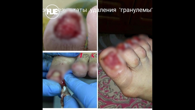 Мастер педикюра избавляет клиентов от ногтевых пластин