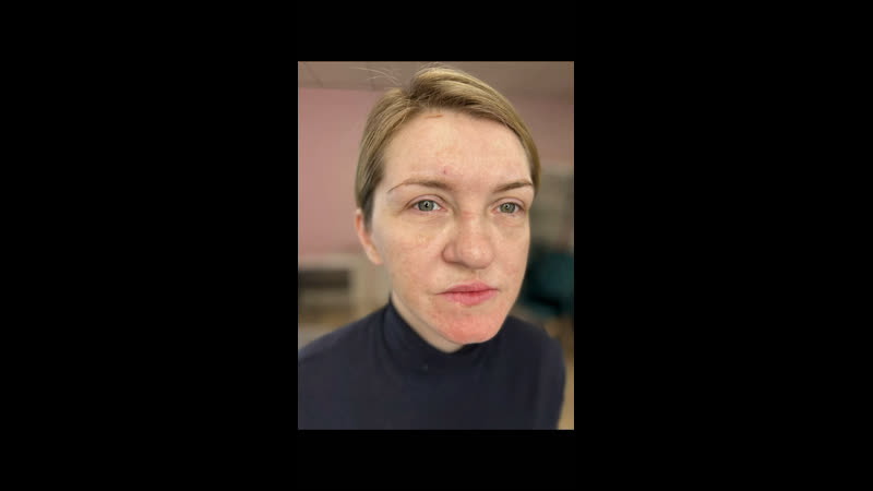 Заячья губа пм