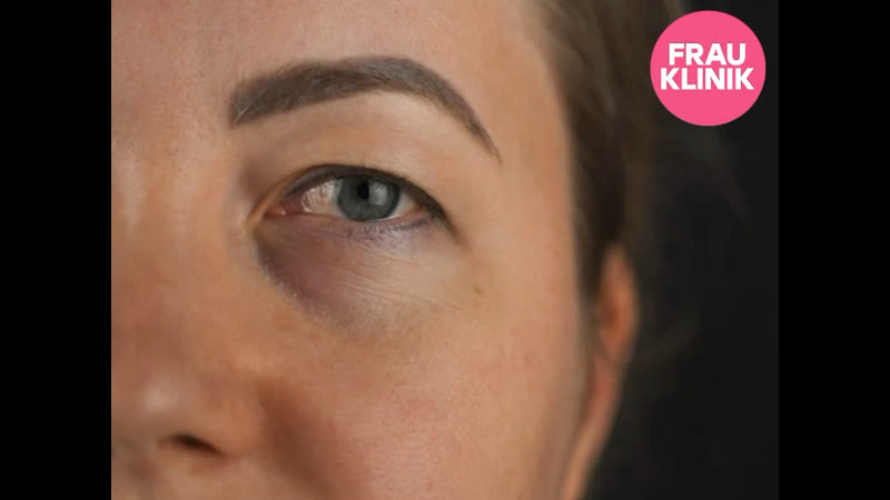 Klinik porn video – Блефаропластика в frau klinik
