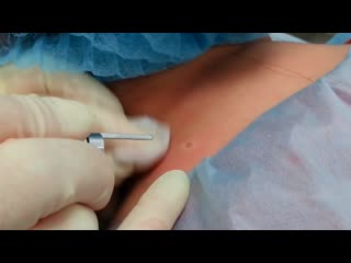 Удаление невуса (родинки) с помощью лазера