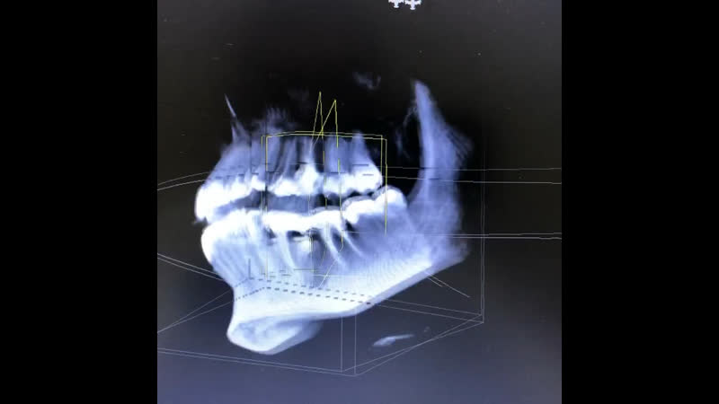 Компьютерная томограмма