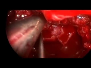 32 эндоскопическое удаление опухоли гипофиза