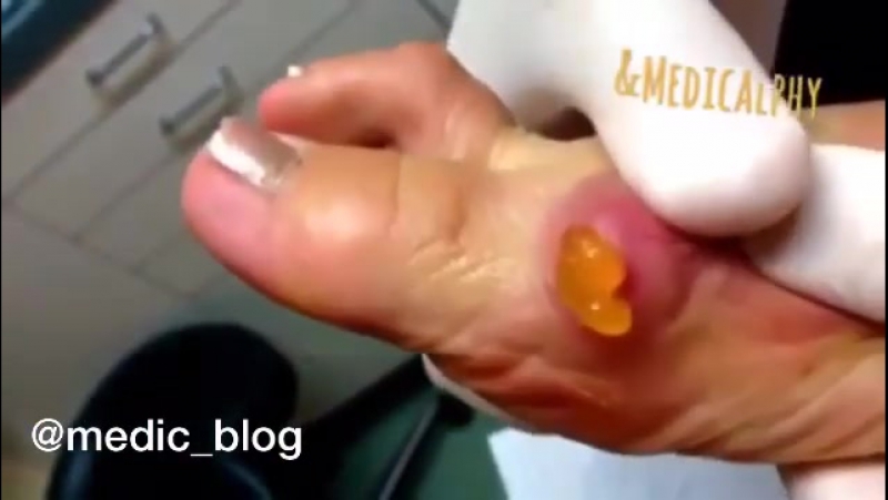 Киста porn video – Синовиальная киста