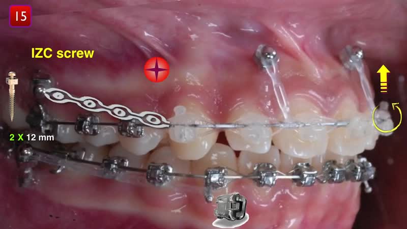 Gummy smile aao 2019 part 2 ортодонтия