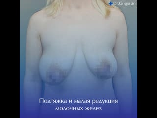 Подтяжка и малая редукция молочных желез