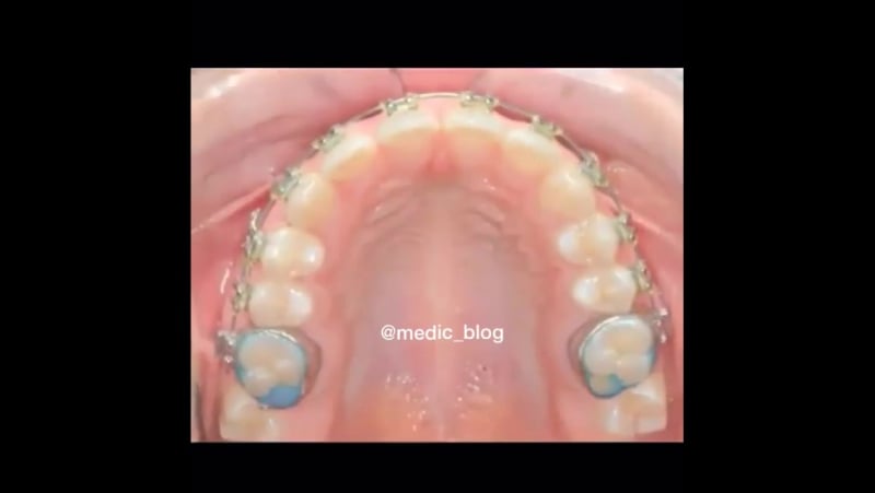 Вот почему стоит не стесняться и носить брекеты