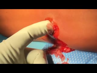 Инфекция из за раны от когтей кота