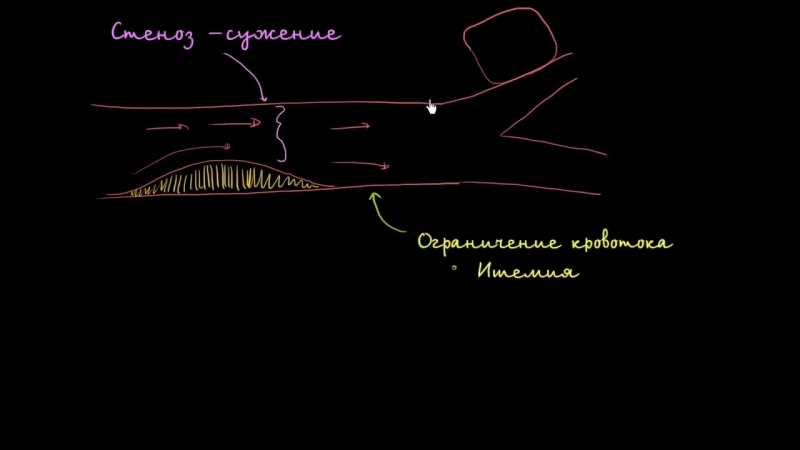 Стеноз, ишемия и сердечная недостаточность