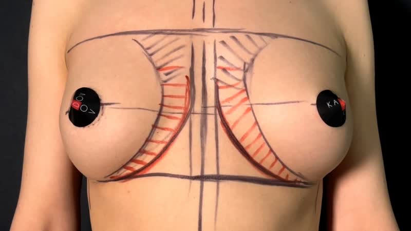 Вторичная маммопластика / пластический хирург кардов хазрит музаринович