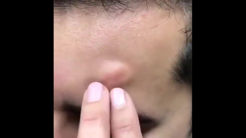 Жировая опухоль, жировик