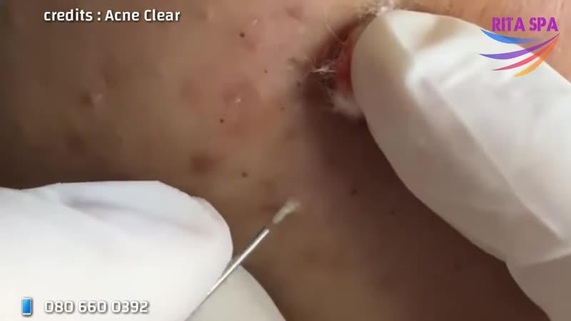 Черные точки, угри, воспаленные прыщи очень аккуратное выдавливание