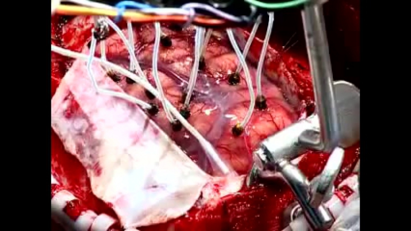 76 трепанация черепа при опухоли головного мозга