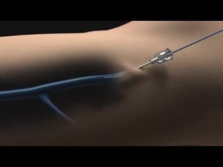 No knife endovenous laser animation of scarless varicose vein