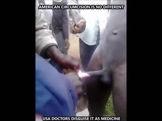 American circumcision