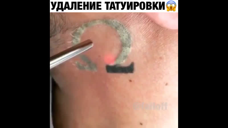 Удаление татуирои