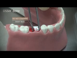 Video tips how to use ossix bone for socket preservation following extraction