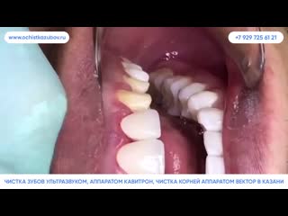 Ochistkazubov ru – комплексная профессиональная чистка зубов в казани
