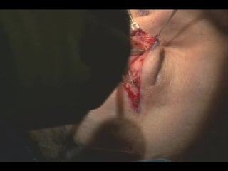 Upper eyelid surgery or blepharoplasty