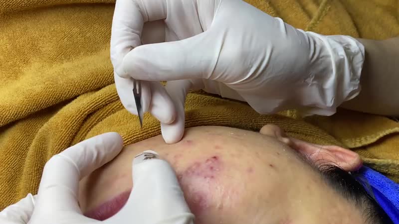 Черные точки, угри, воспаленные прыщи