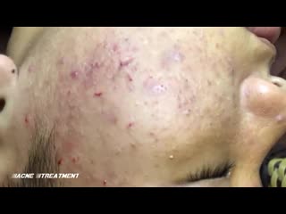 Чистка лица много черных точек