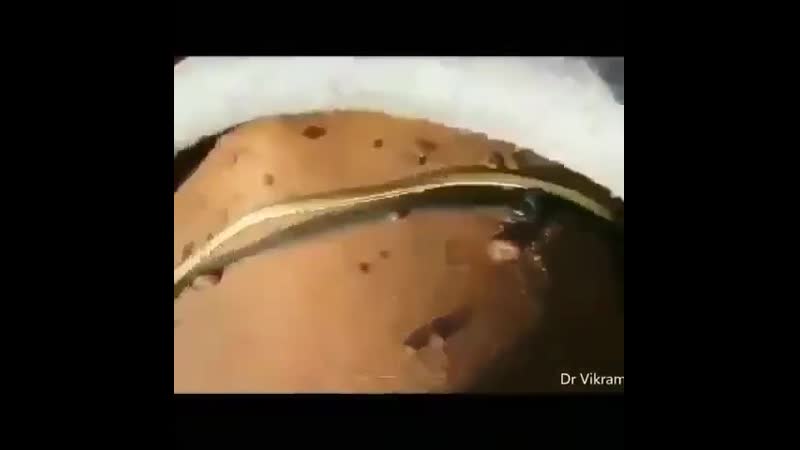 Туберозный склероз