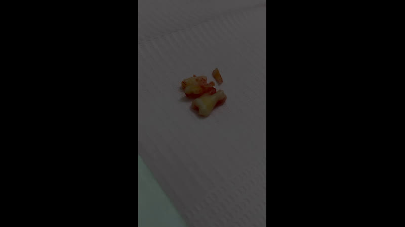 Удаление зуба мудрости🦷