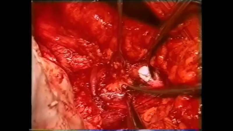 Расширенная субтотальная дистальная резекция желудка