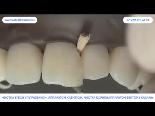 – чистка зубов air flow в казани