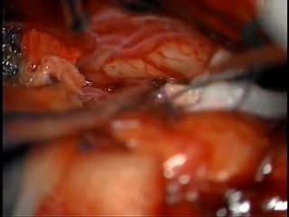 61 клипирование аневризмы перикаллезной артерии