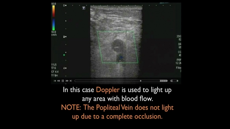 Vein porn video – 5 ultrasound deep vein thrombosis