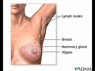 Breast cancer symptoms