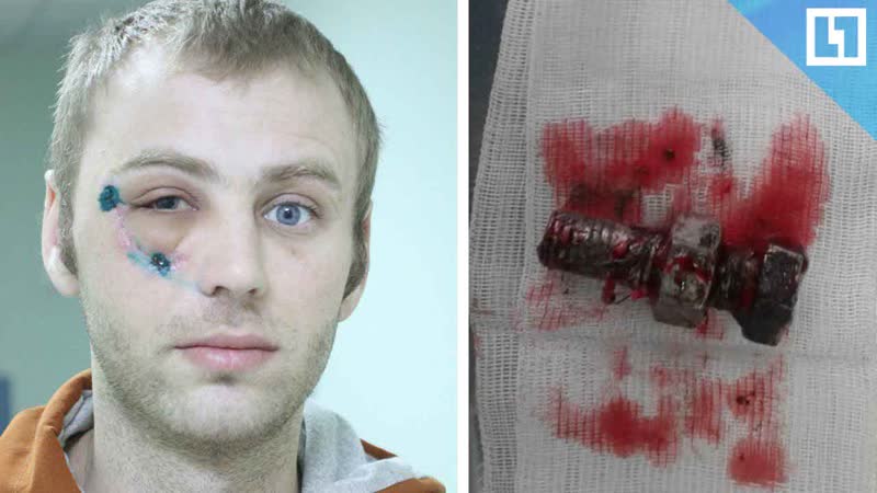 Огромный болт пробил голову