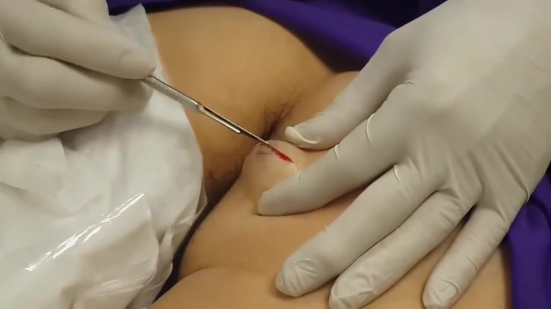 Удаление атеромы на ягодице