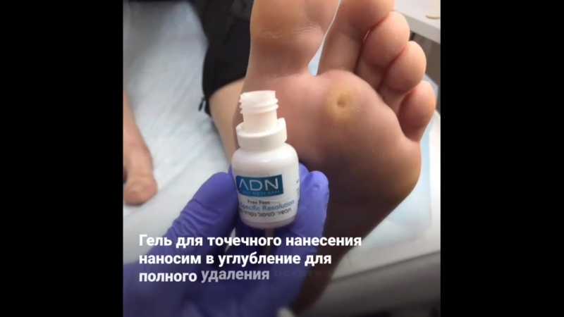 Стержневая мозоль удаление