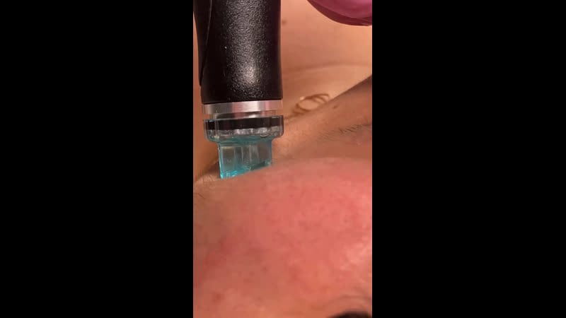 🔹вакуумный гидропилинг hydrafacial глубоко очищает поры, интенсивно питает кожу, делает ее гладкой и упругой