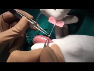 Tese icsi testicular sperm extraction using the needle biopsy technique