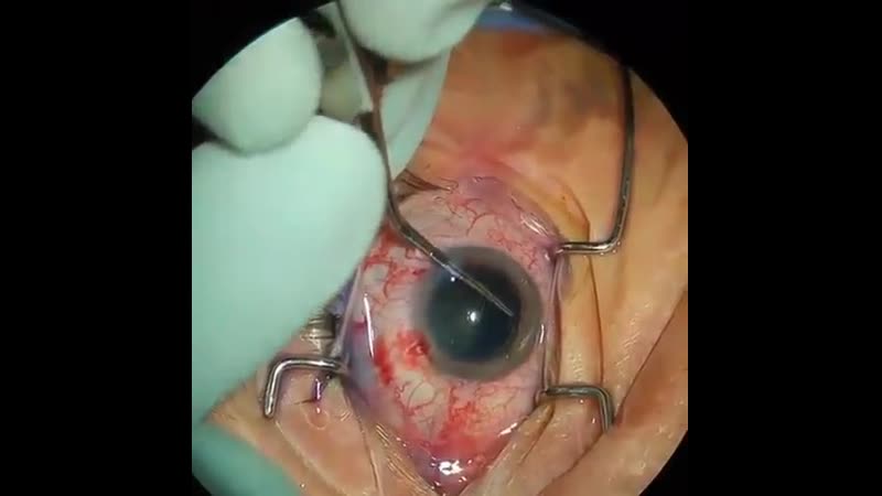 Снятие капсулы с помощью щипцов самый важный шаг в хирургии катаракты 👁