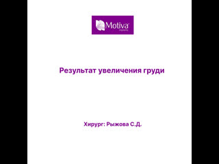 Результат увеличения груди небольшим имплантом