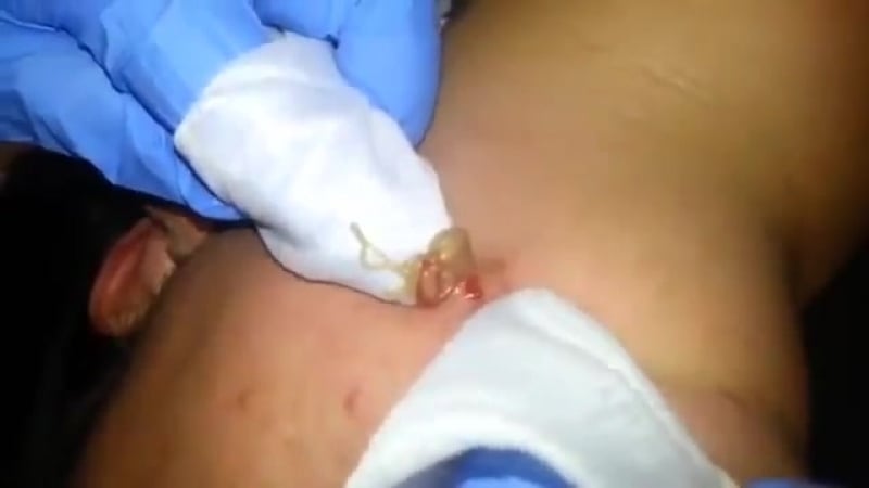 Выдавливание огромного прыща